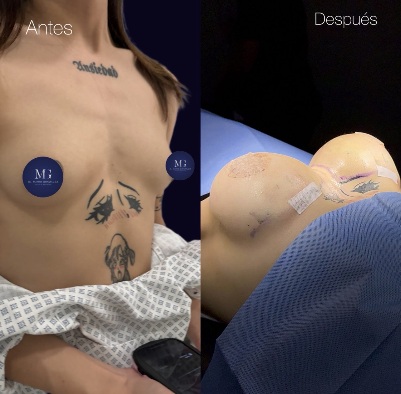 Breast surgery before and after