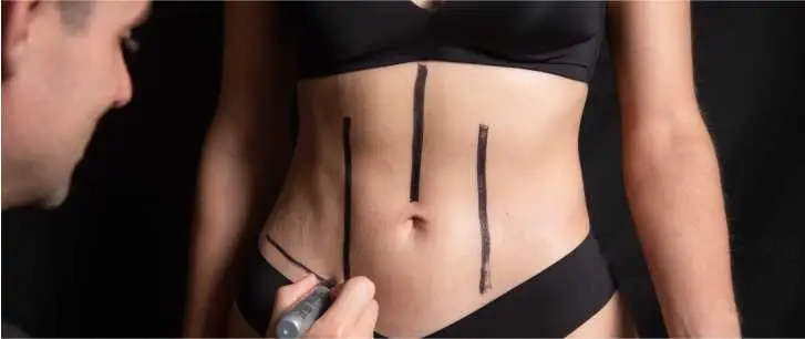 HD liposculpture marking session